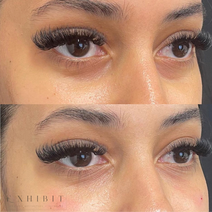 Before and after photos of undereye filler #1