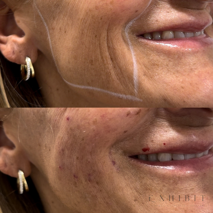Before and after photos of SkinVive #1