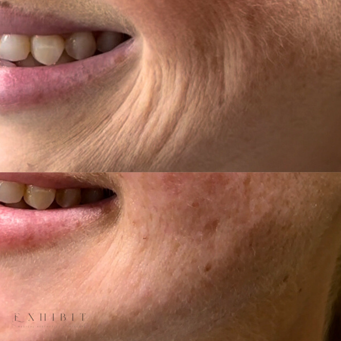 Before and after photos of SkinVive #2