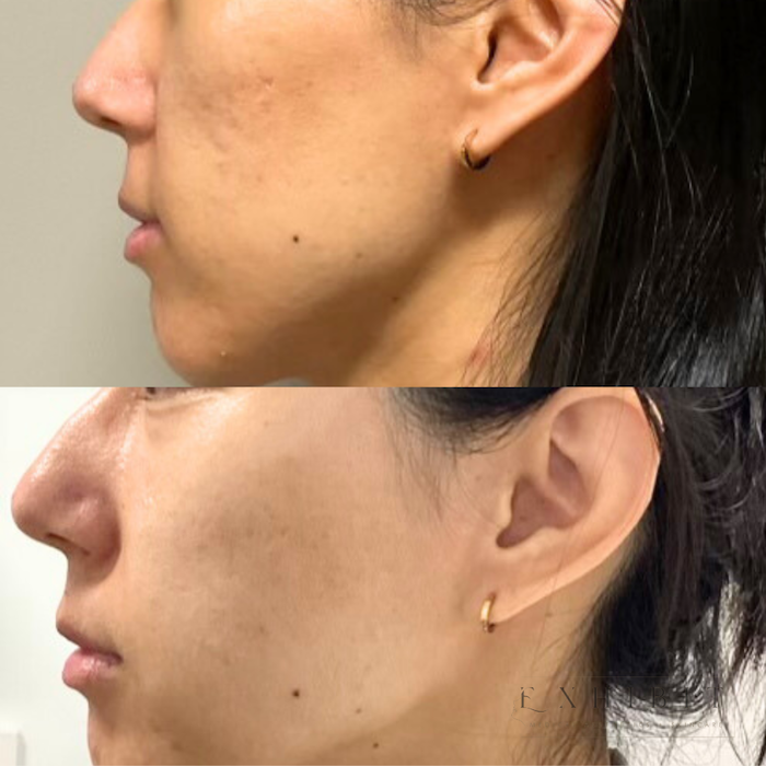 Before and after photos of skinVive #3
