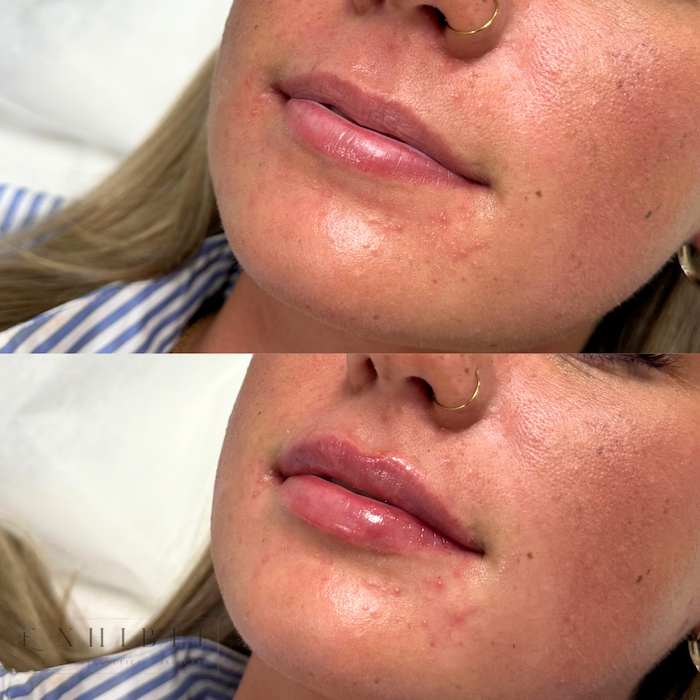 Before and after photo of lip filler #4