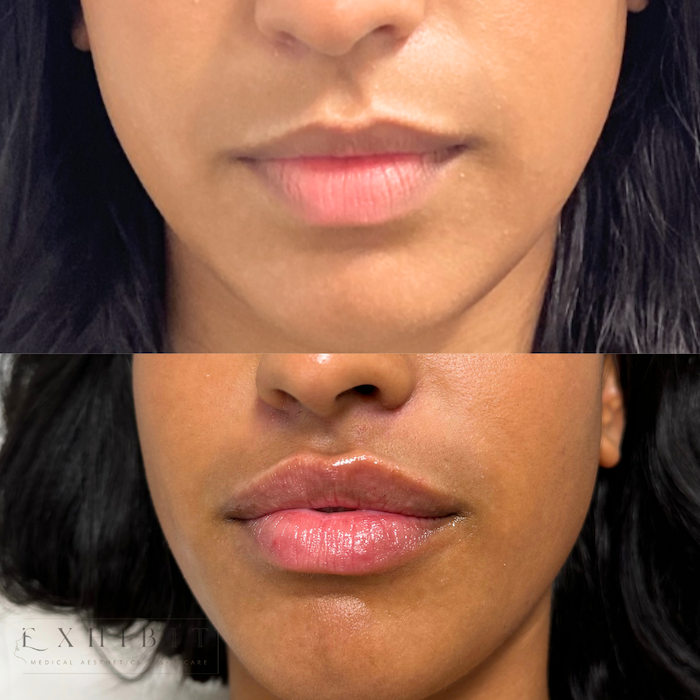 Before and after photo of lip filler #6