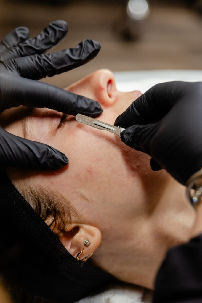 Nurse wearing gloves holds dermaplaner above patient's face