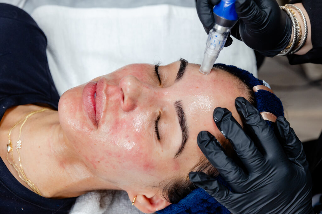 Patient recieving microneedling on forehead