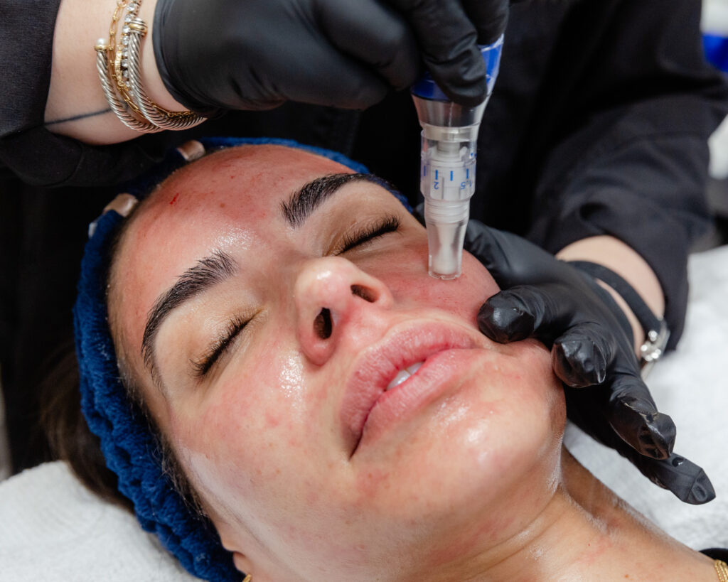 Patient receiving microneedling
