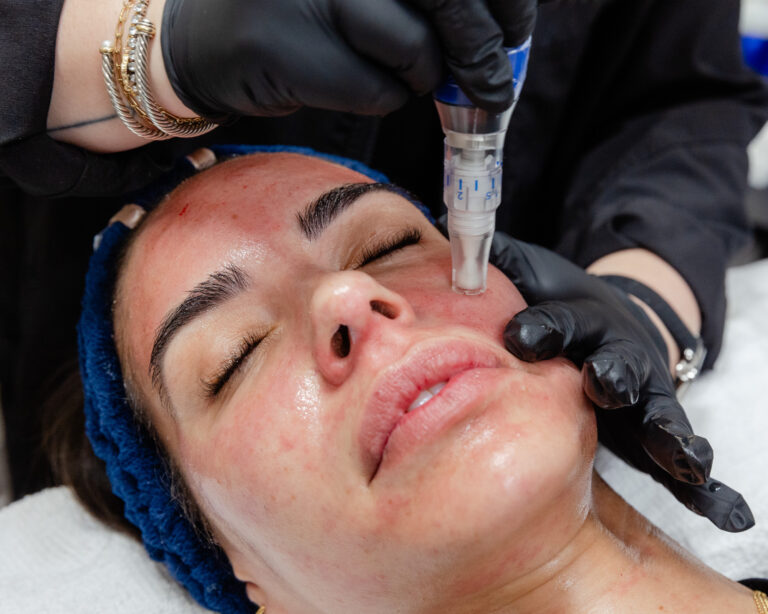 Patient receiving microneedling
