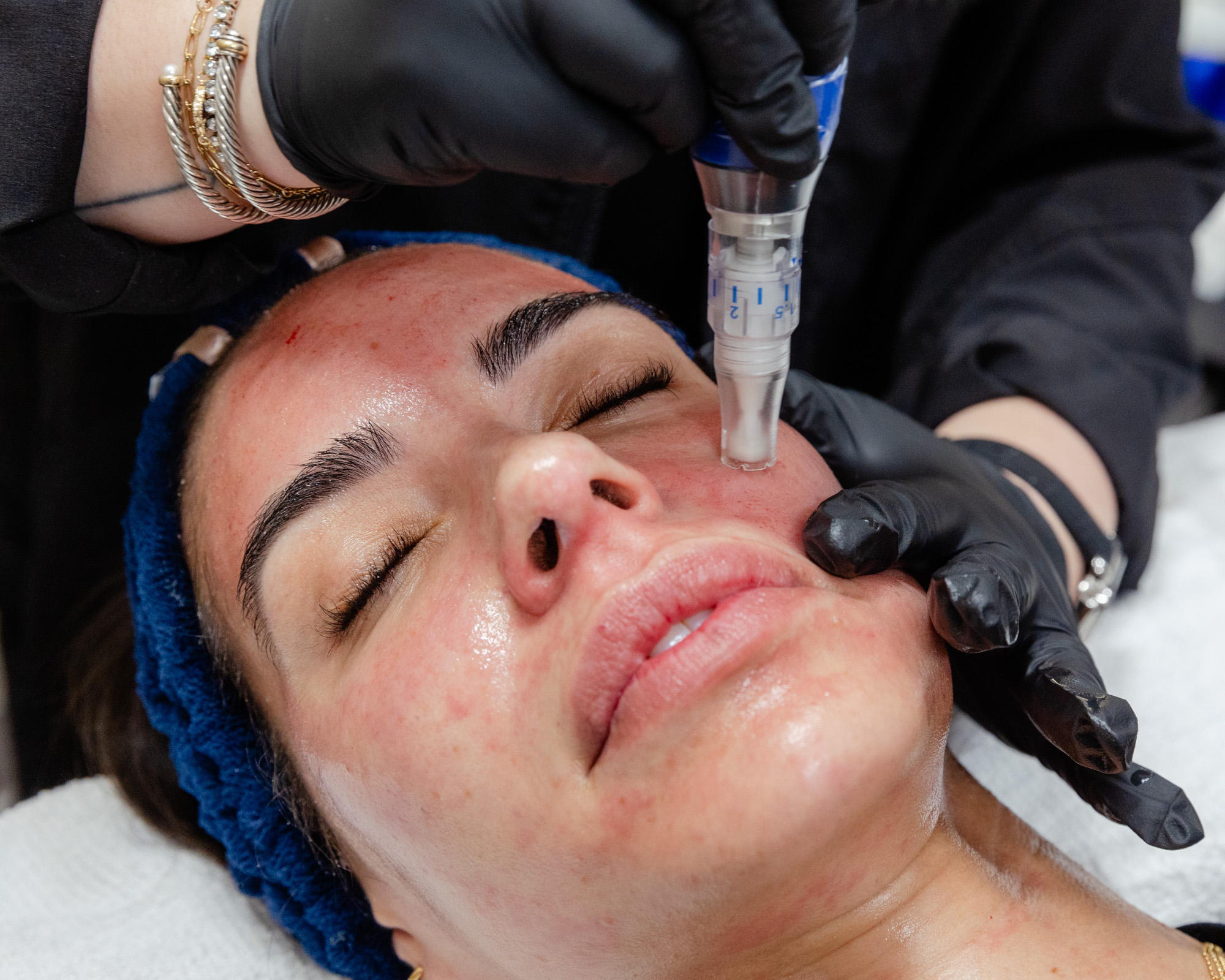 Patient receiving microneedling