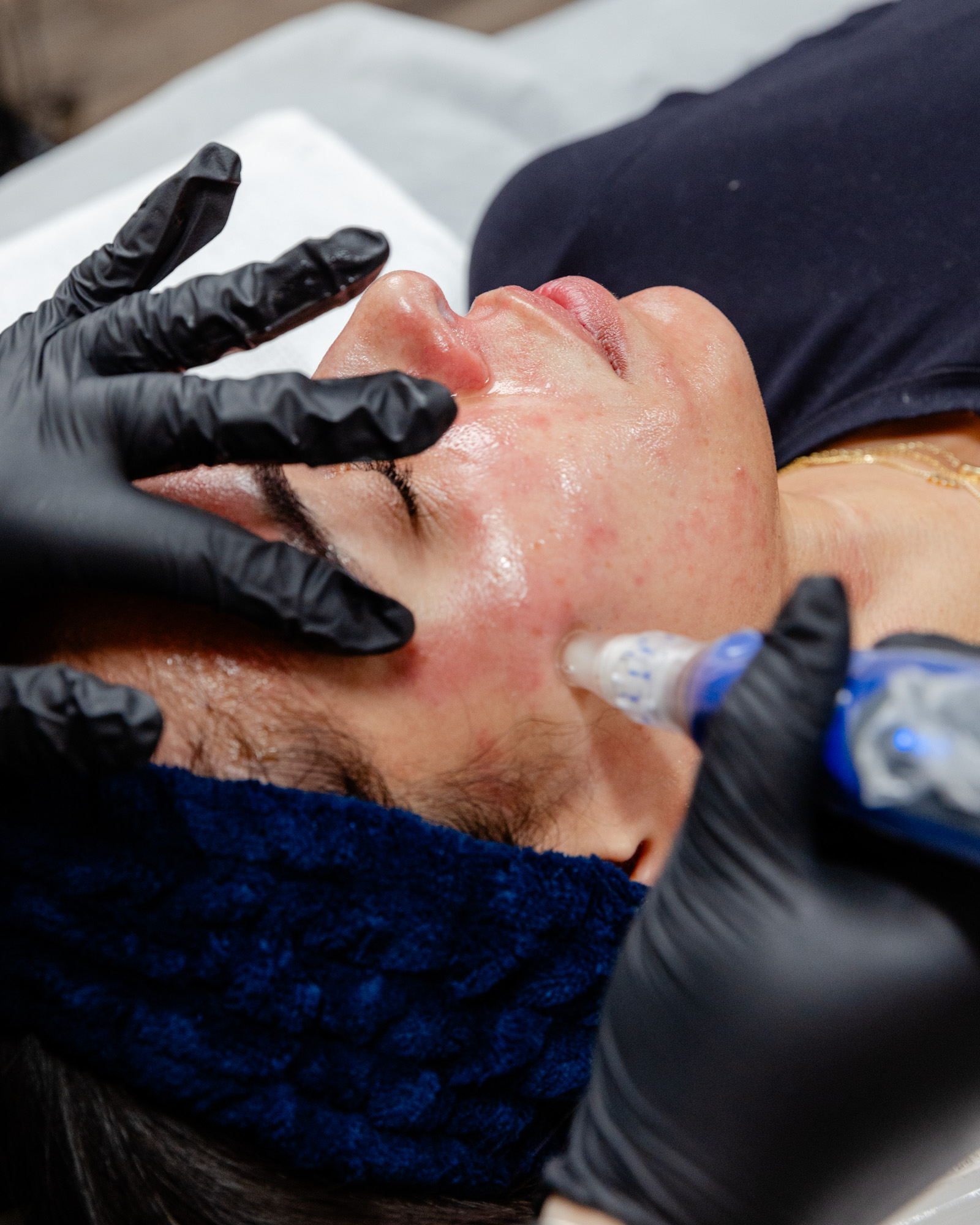 Patient receiving microneedling
