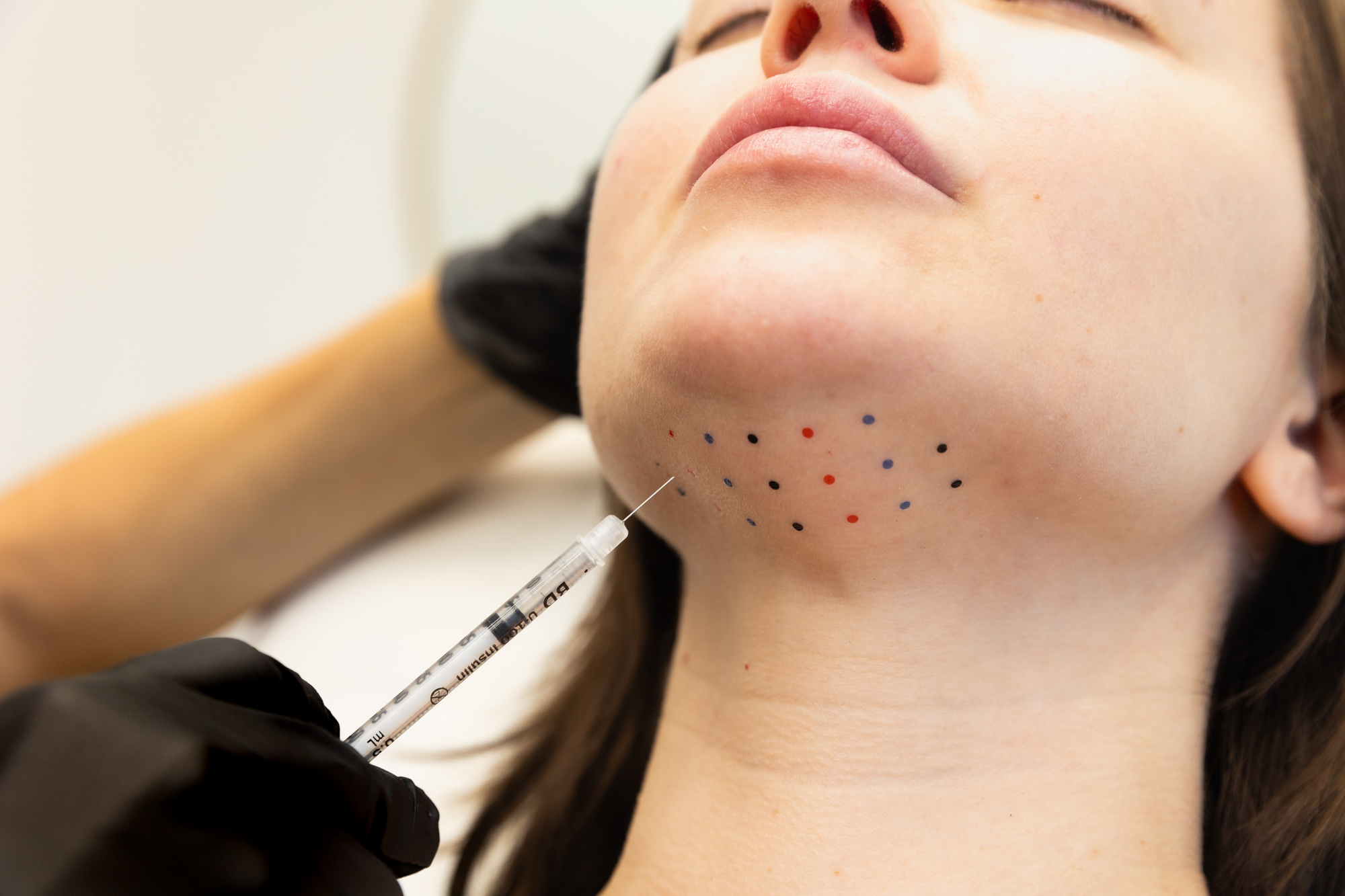 Needle injected into lower chin with small dots marking placement.