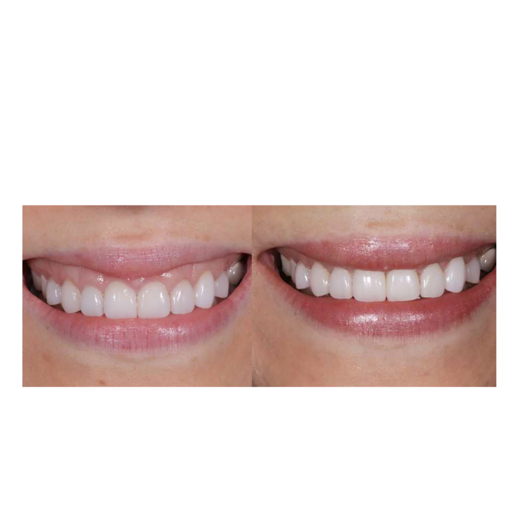 Before and after of gummy smile