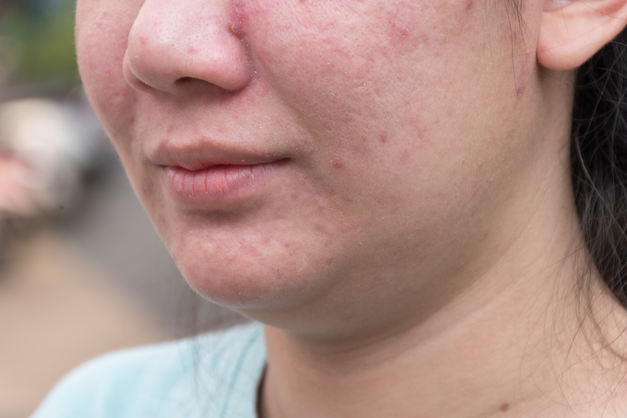 A close up image of a young Asian woman with rosacea, going to visit the team at Exhibit Medical Aesthetics for rosacea treatment in Denville.